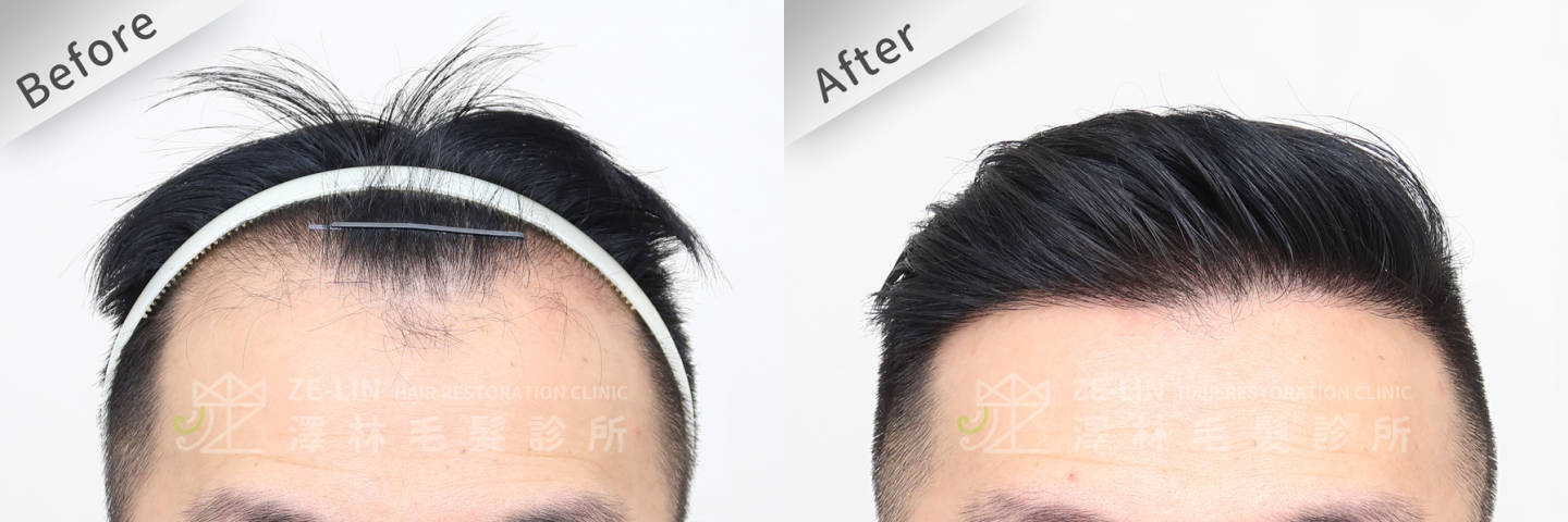 植髮案例3：M型禿髮術前術後對照圖