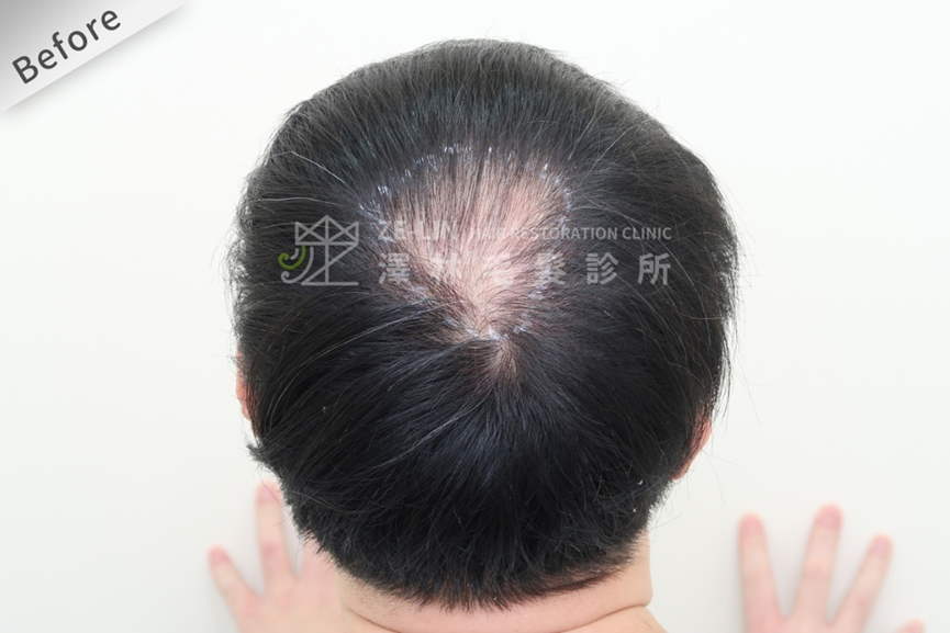 地中海禿頭髮型示意圖