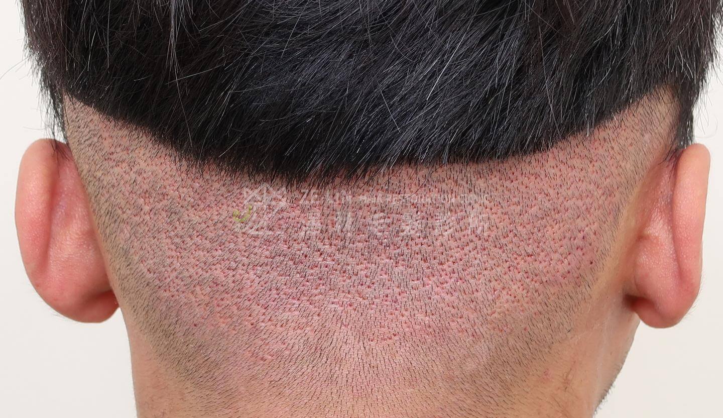 植髮副作用：FUE植髮造成的傷口
