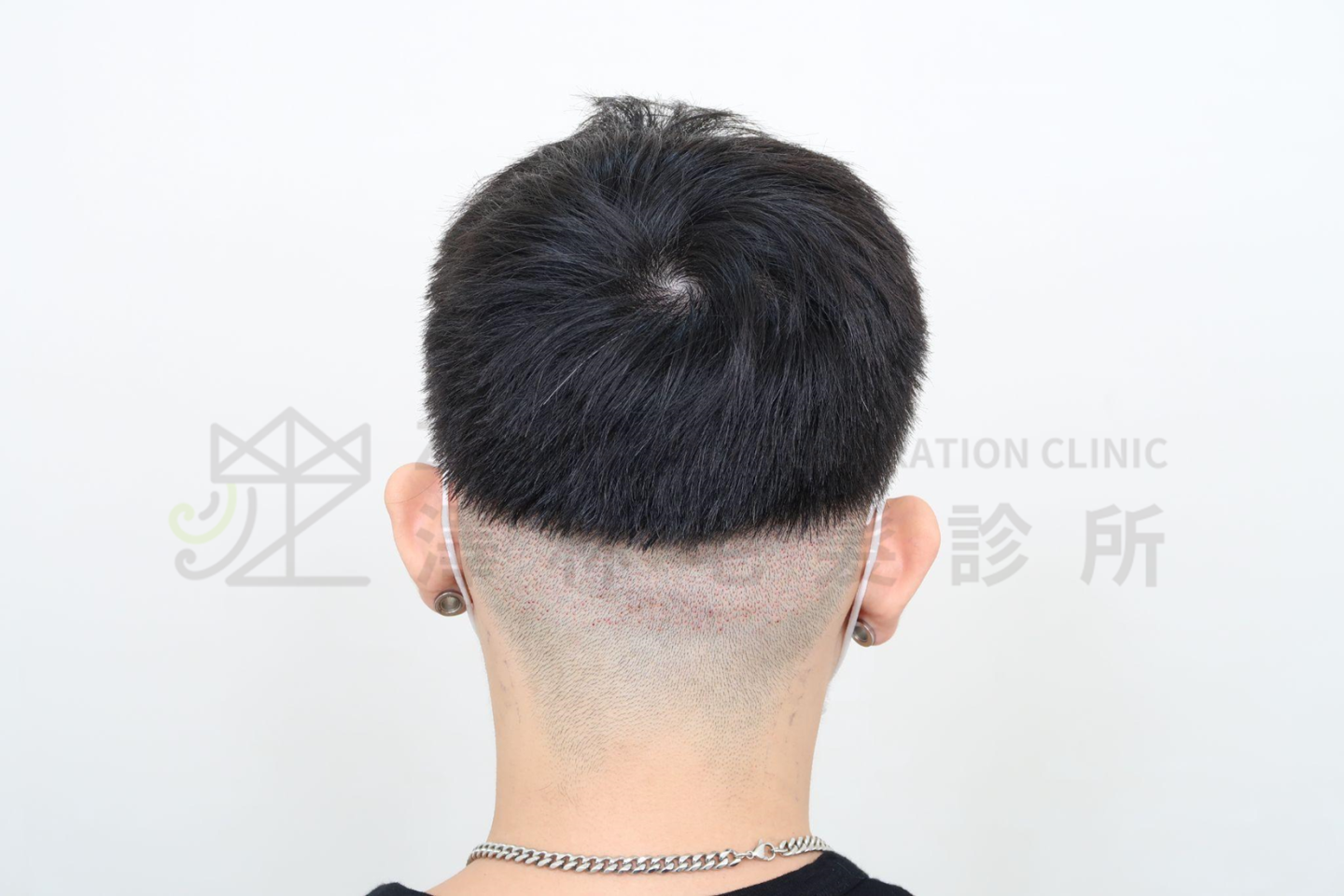 FUE植髮以微小鑽取器分散取下後枕部毛囊