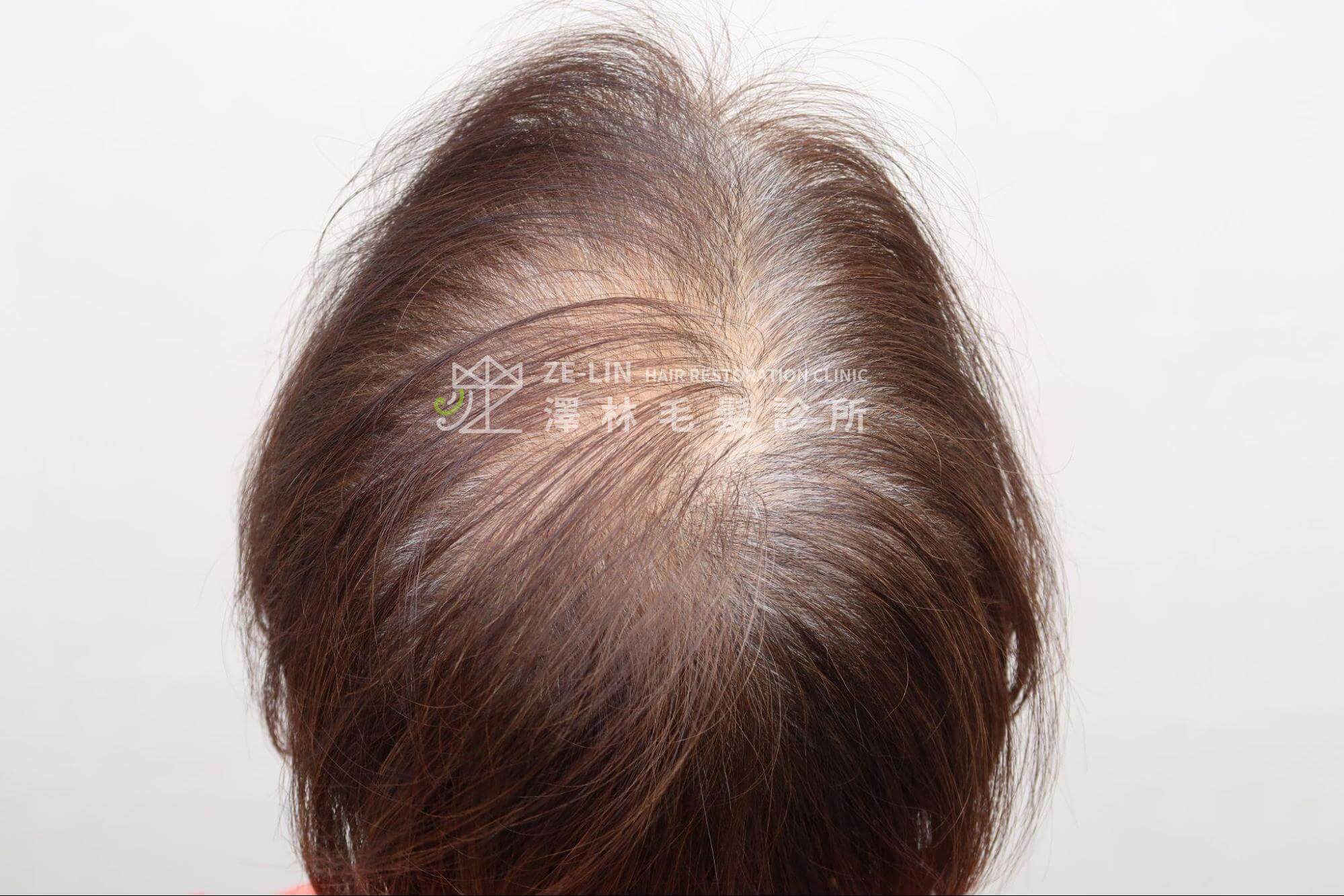 女性雄性禿判斷：類似「女生雄性禿」脫髮表現的更年期後落髮