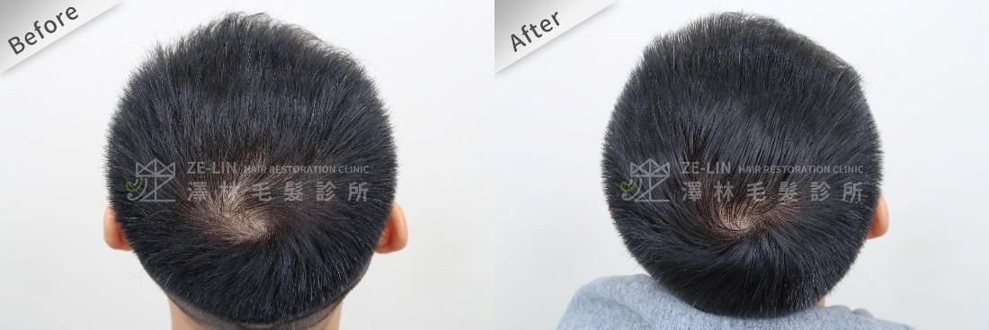 掉髮治療可提升頭髮密度