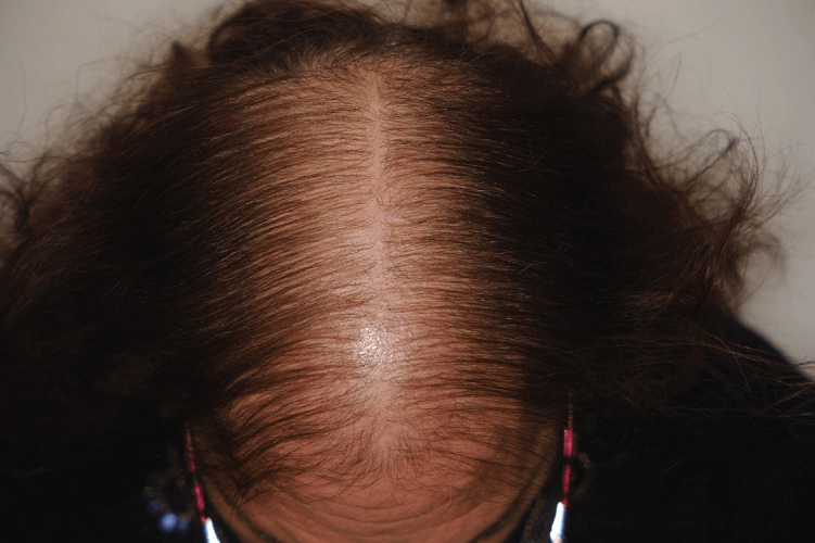 女性雄性禿判斷：第二期女性雄性禿案例
