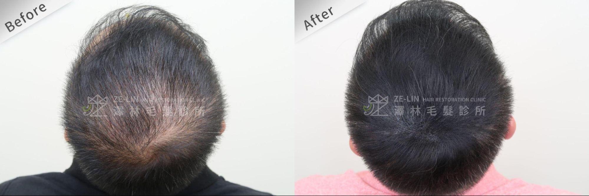 紋髮治療可作出擬似髮根的效果