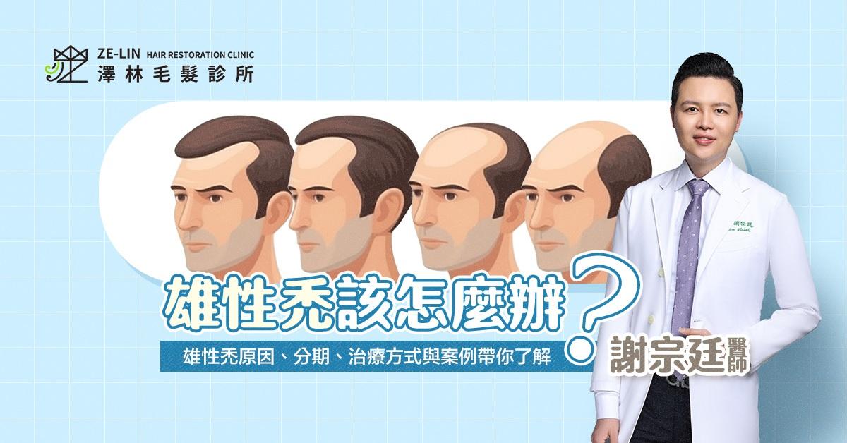 替代文字=雄性禿怎麼辦？