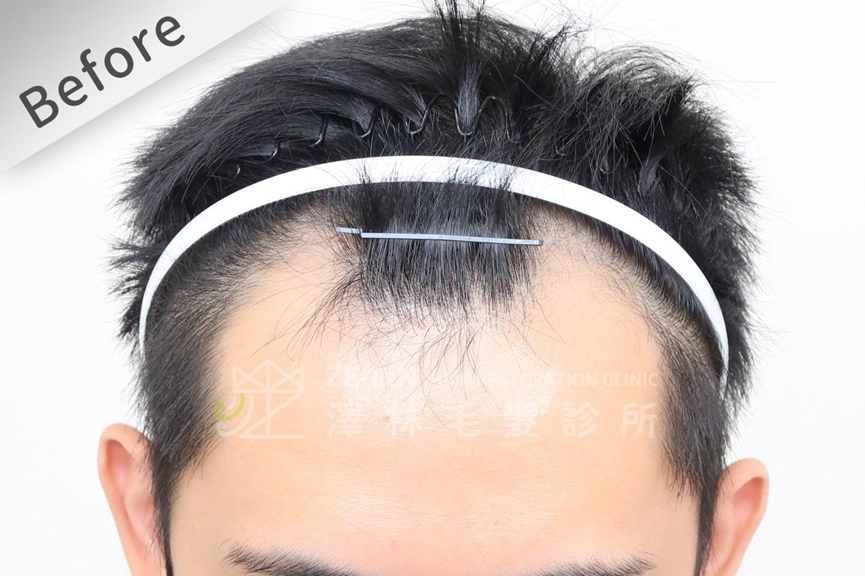 m型禿髮型示意圖