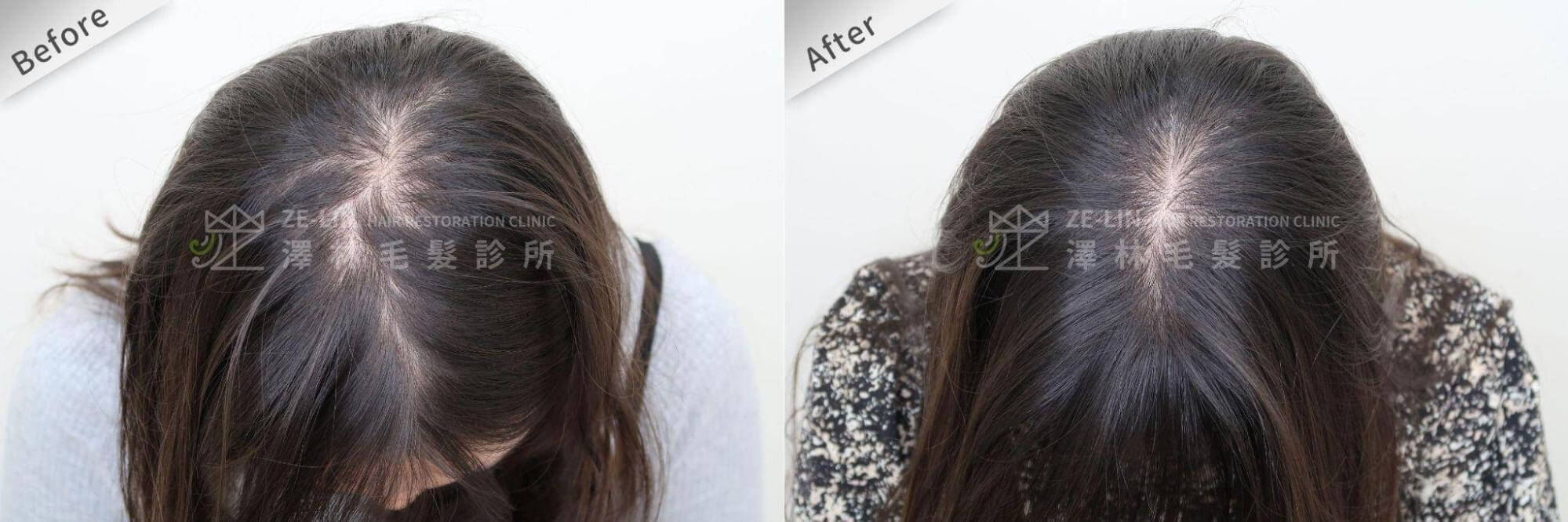 女生雄性禿也可以透過生髮療程進行改善