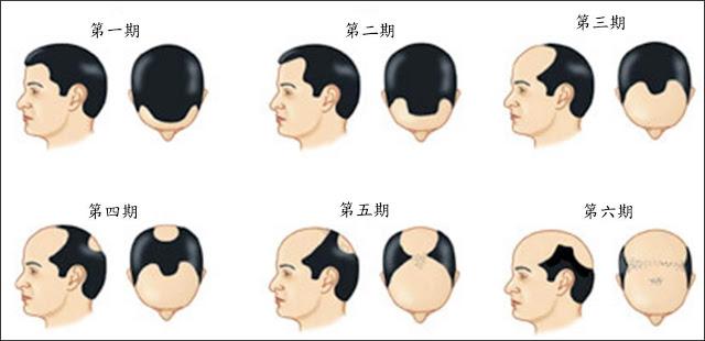 M型禿治療根據不同落髮階段