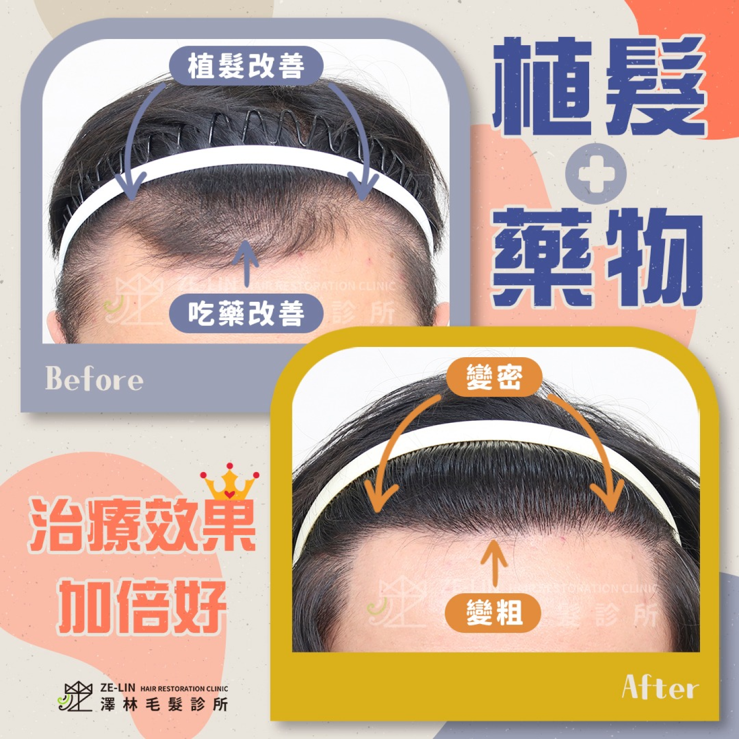 雄性禿有救嗎？藉由藥物和植髮手術的雙重治療，可以達到最佳的髮量恢復效果