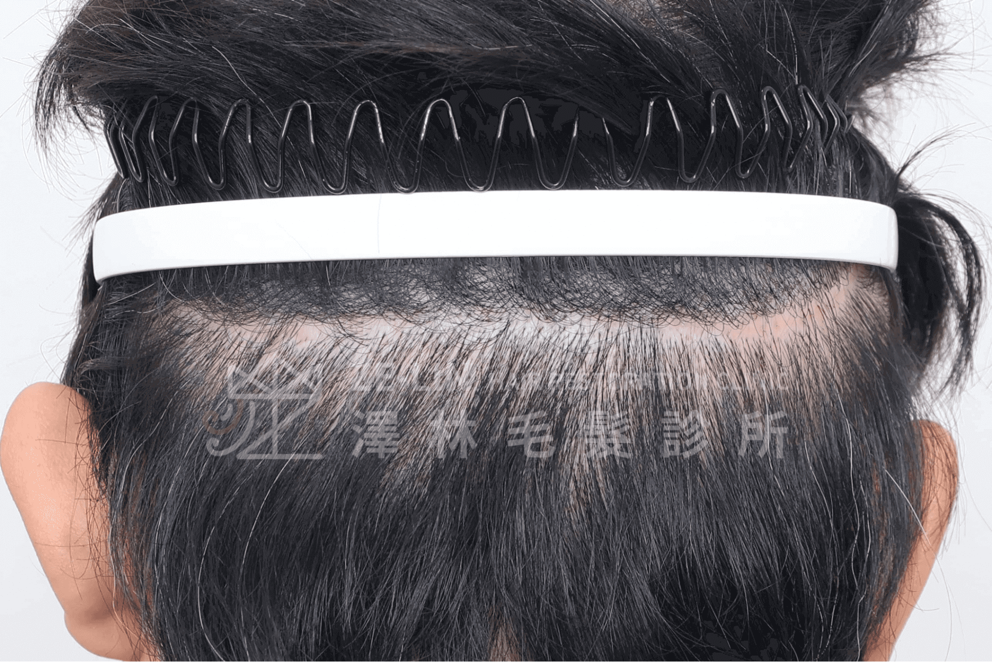 FUT植髮會痛嗎？植髮值得嗎？