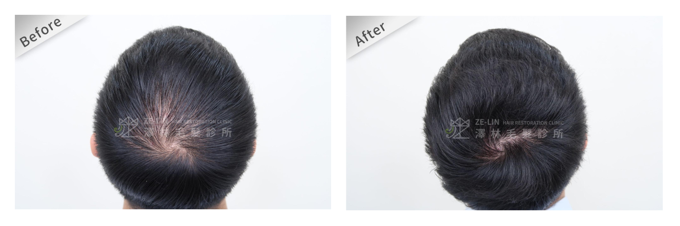 髮旋禿治療方法：植髮