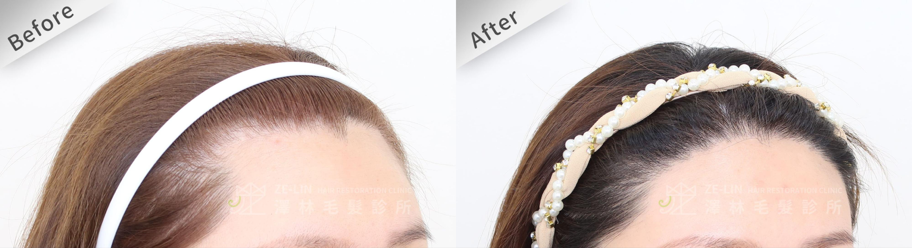 髮際線植髮推薦免剃髮植髮