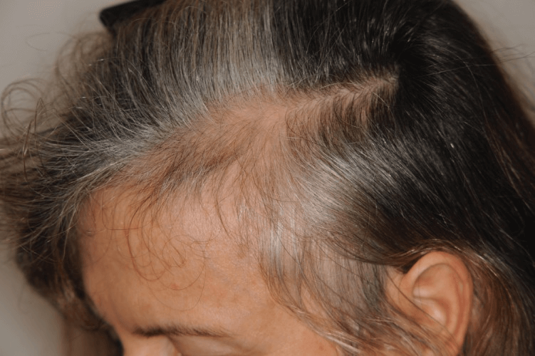 女性雄性禿判斷：慢性休止期落髮與雄性禿差異