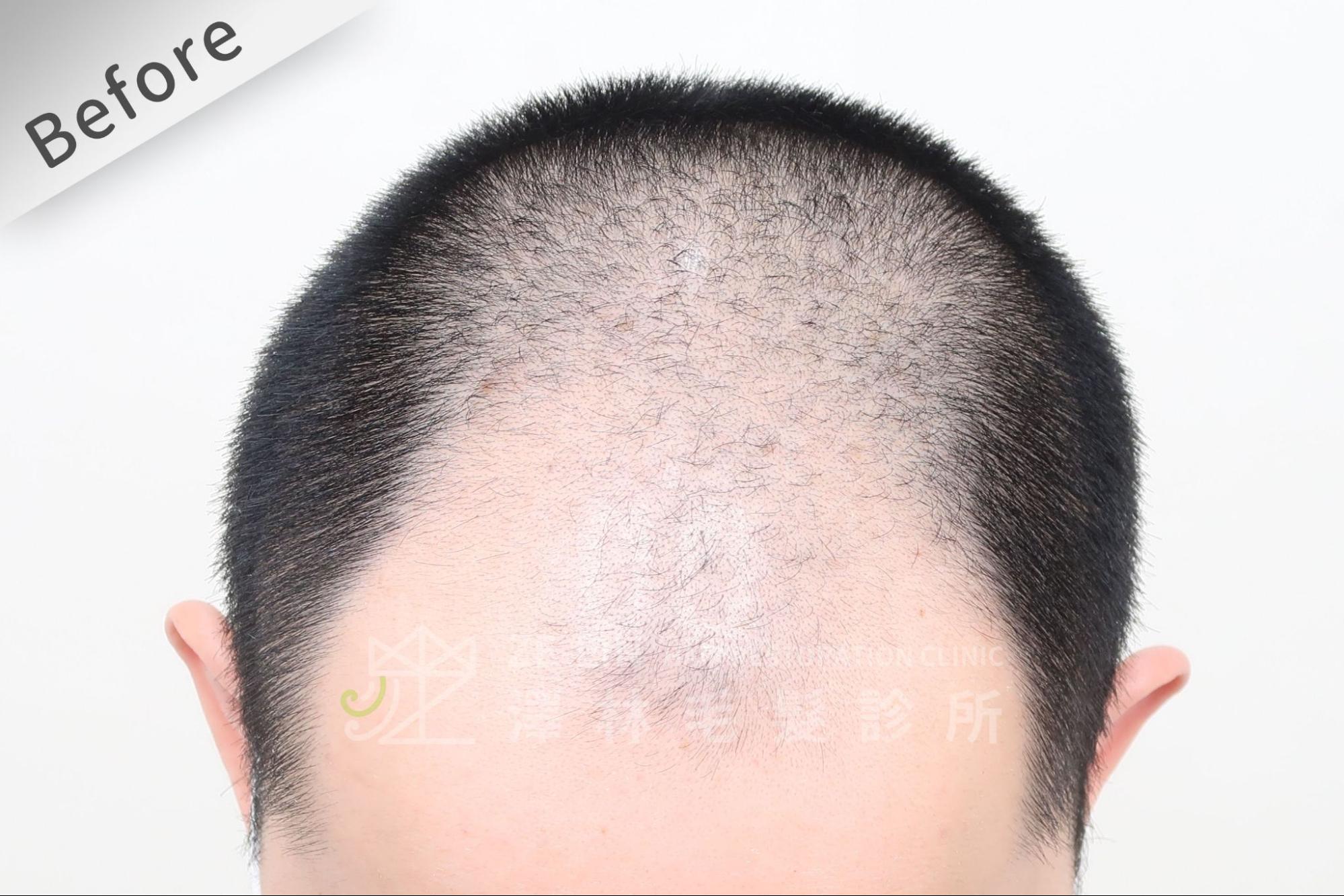 雄性禿典型表現為前額及頂部頭髮變細、髮量稀疏