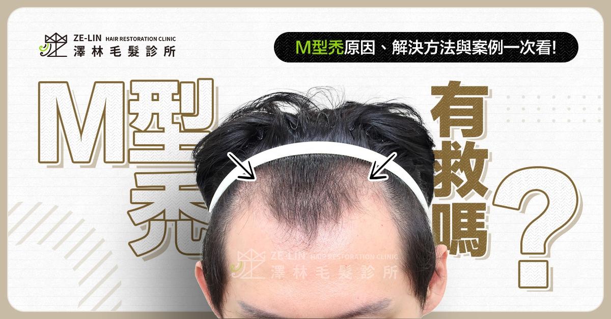 m型禿有救嗎？搶救手法一次看