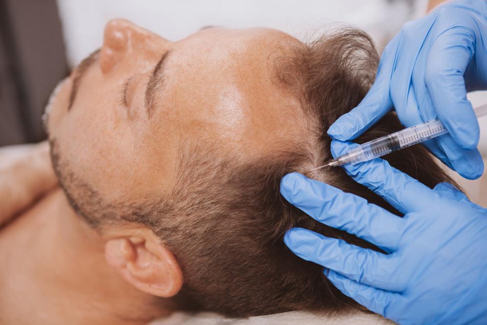 PRP治療可以刺激頭髮生長