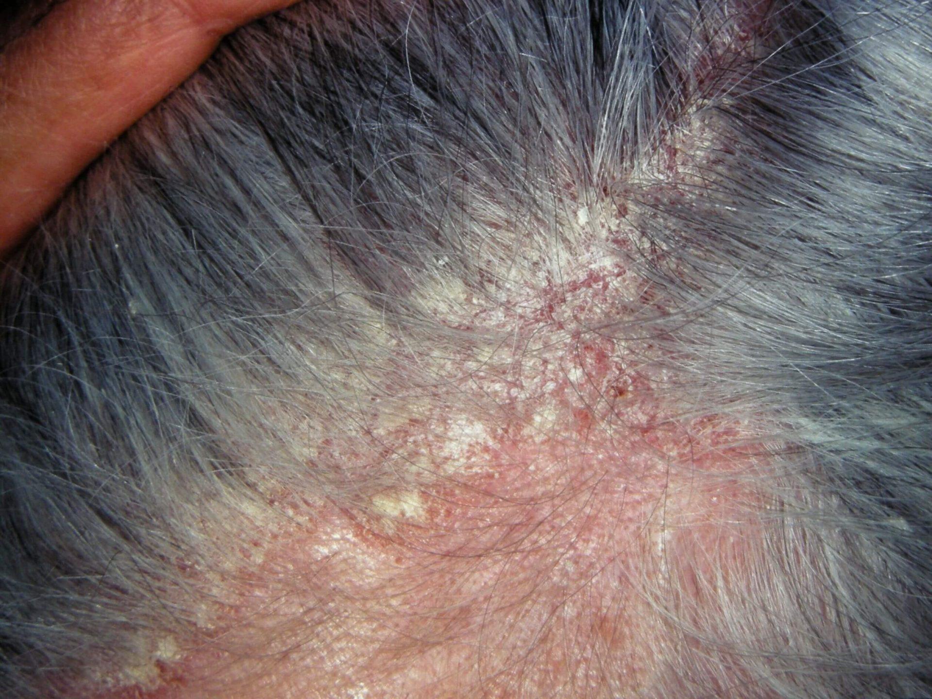 頭皮脂漏性皮膚炎典型症狀：發炎、發癢、脫屑