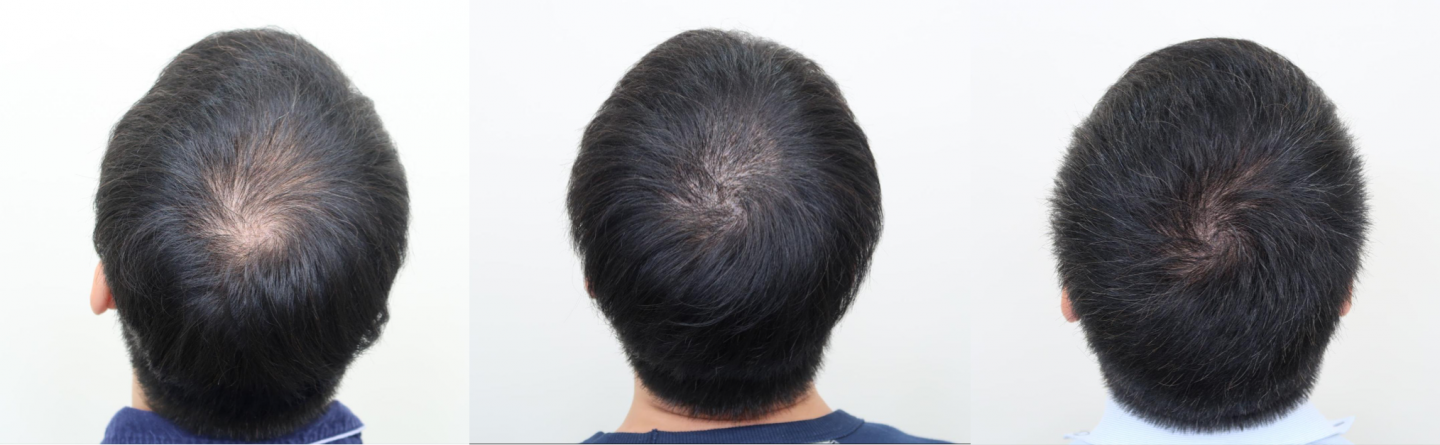 分層剃髮FUE手術效果