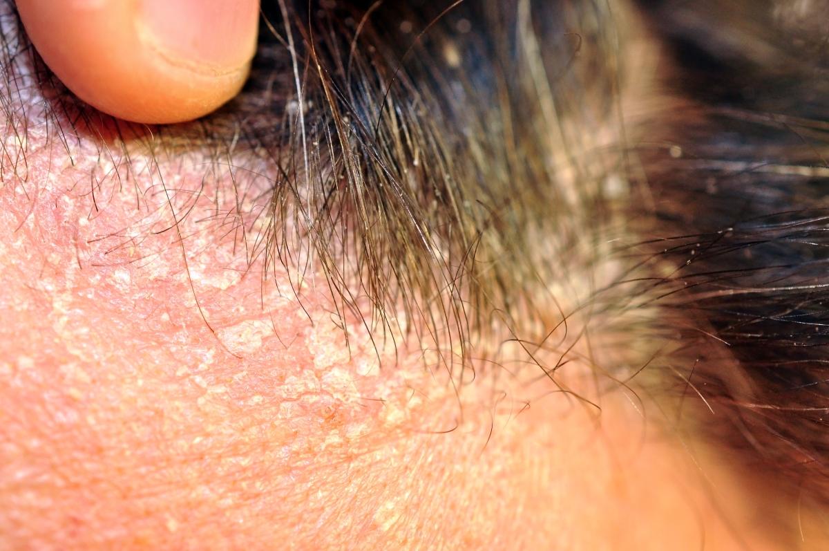 過多頭皮油脂易導致脂漏性皮膚炎，造成頭皮癢及頭皮屑