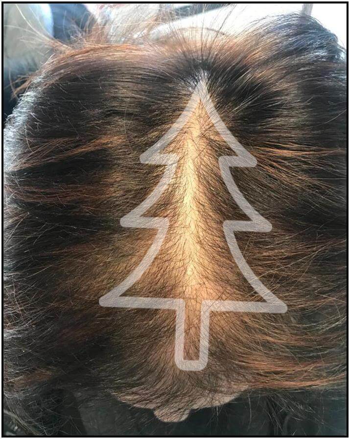 女性雄性禿判斷：​​聖誕樹型態落髮