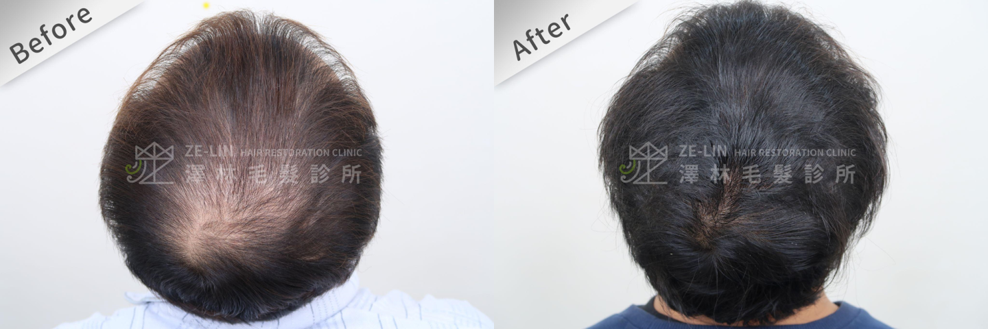 植髮案例2：地中海禿術前術後對照圖