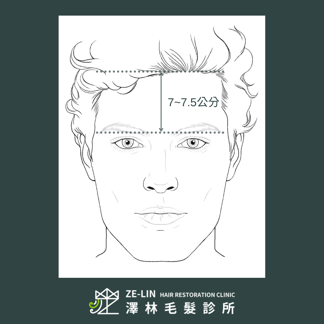 髮線後移可透過額頭高度自我檢測