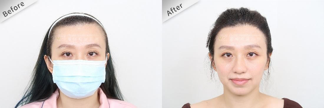 女性美型髮際線植髮手術，對整體外觀大大加分
