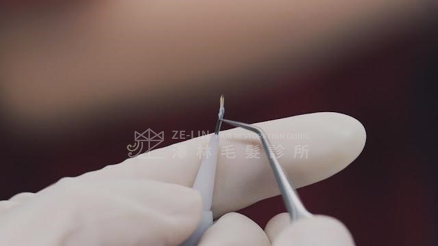 禿頭遺傳第一期症狀