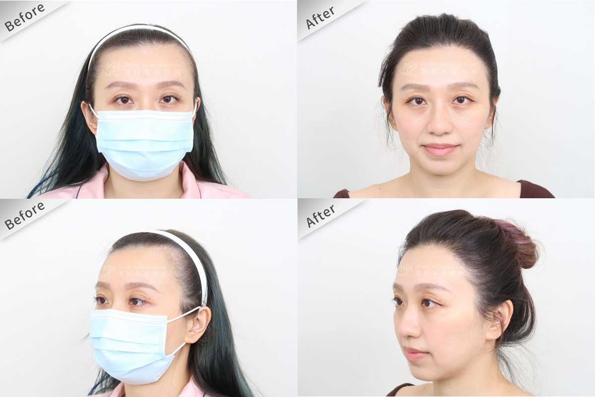 禿頭遺傳第三期症狀