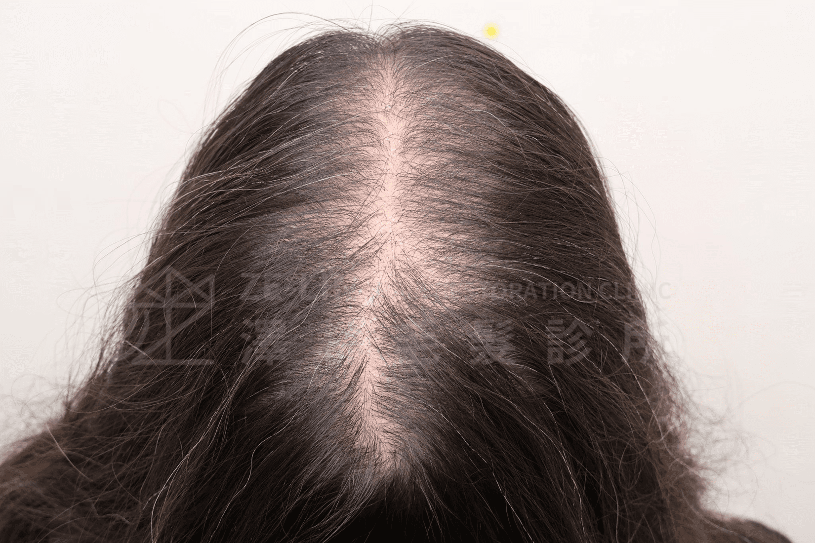 女性禿頭遺傳症狀