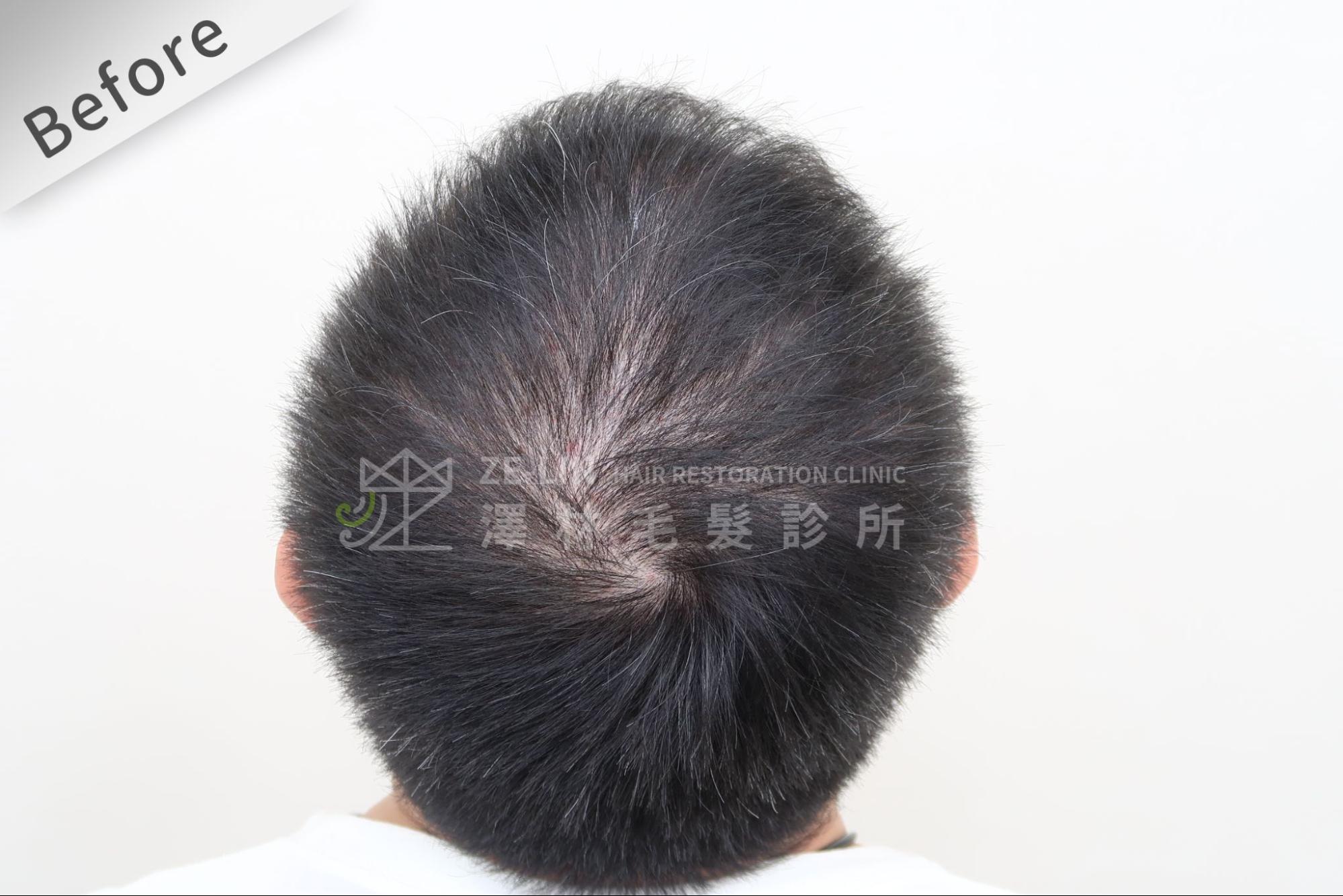 生髮水應搭配不同的專業生髮治療方式才有用