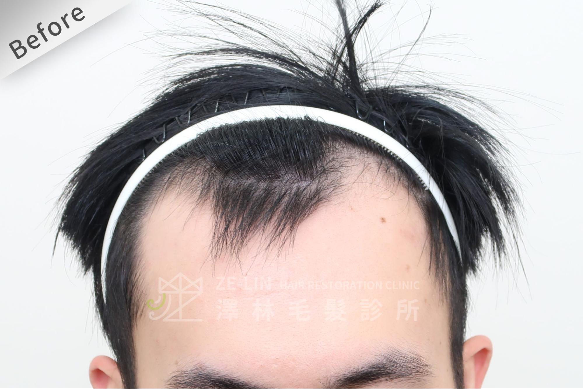 生髮水對已經處於M型禿狀態的髮友治療效果不佳