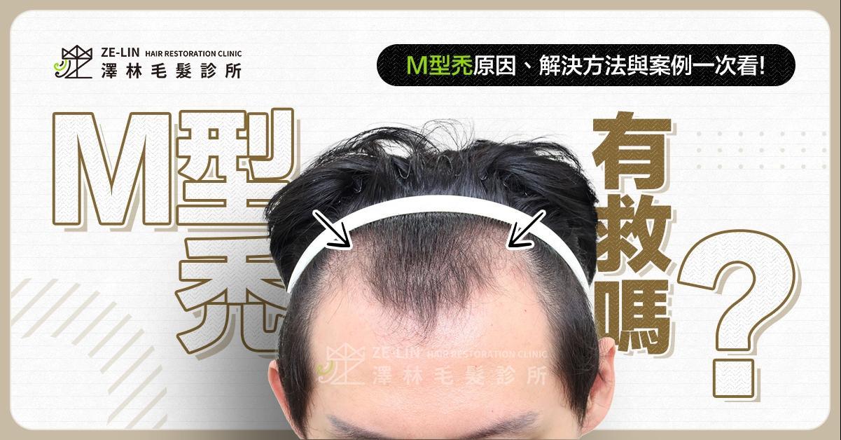 M型禿治療