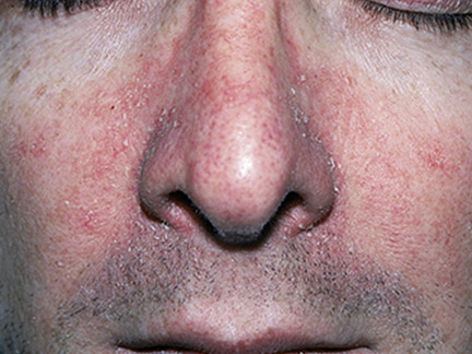 頭皮脂漏性皮膚炎在臉部表現