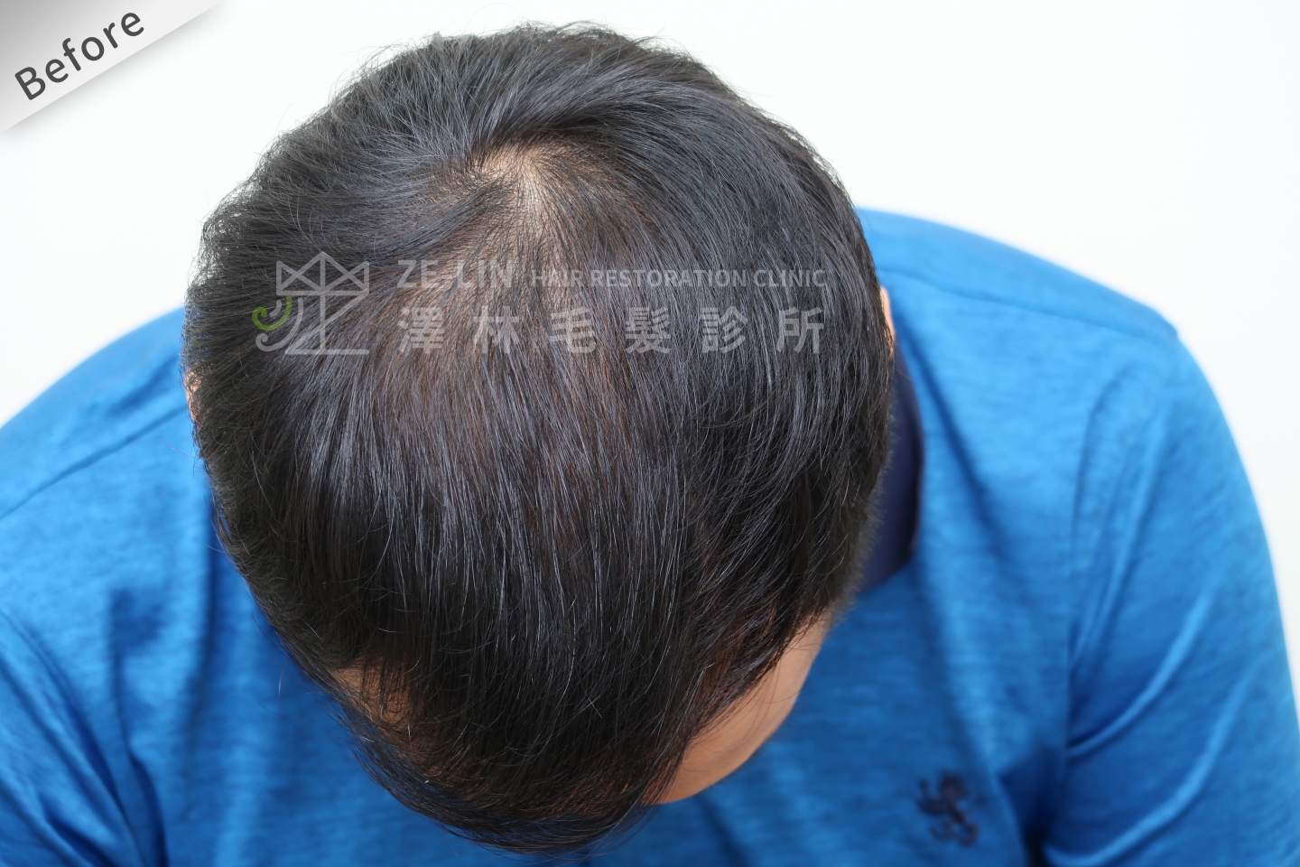 生髮育髮治療PRP自體生長因子注射雄性禿治療頂部術前5