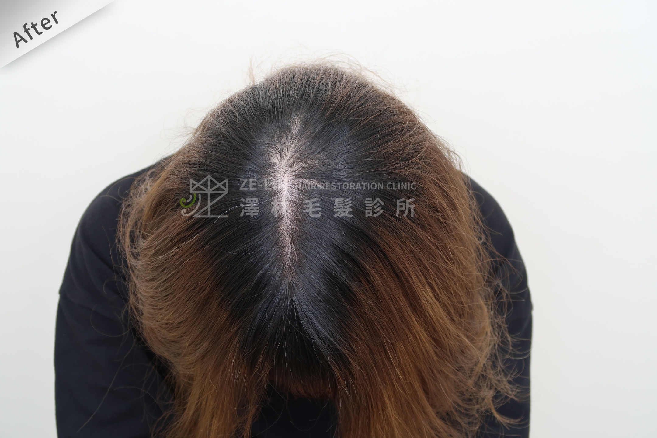 PRP自體生長因子育髮治療女生雄性禿改善頭頂看到頭皮術後（２）
