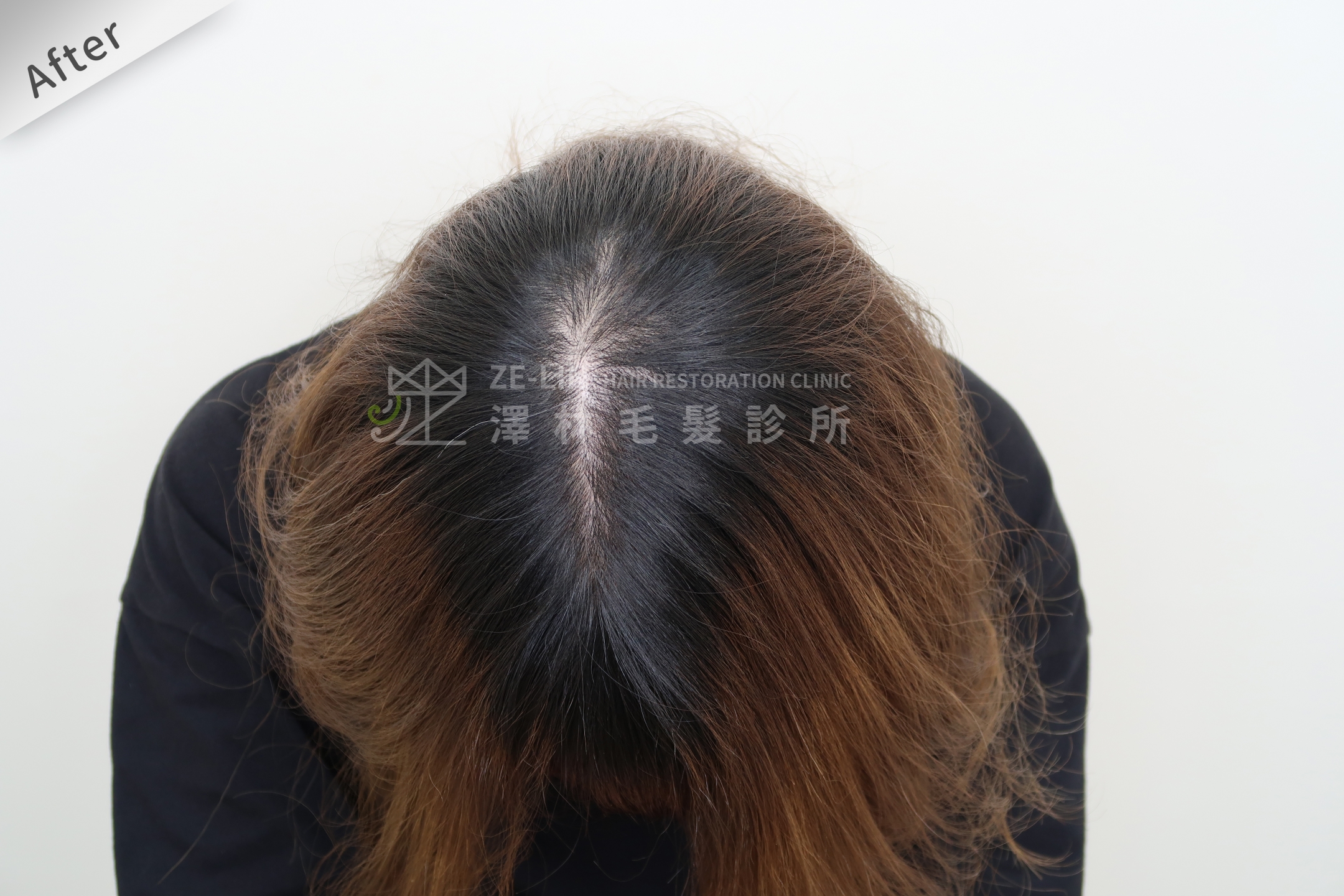 PRP自體生長因子育髮治療女生雄性禿改善頭頂看到頭皮術後(2)
