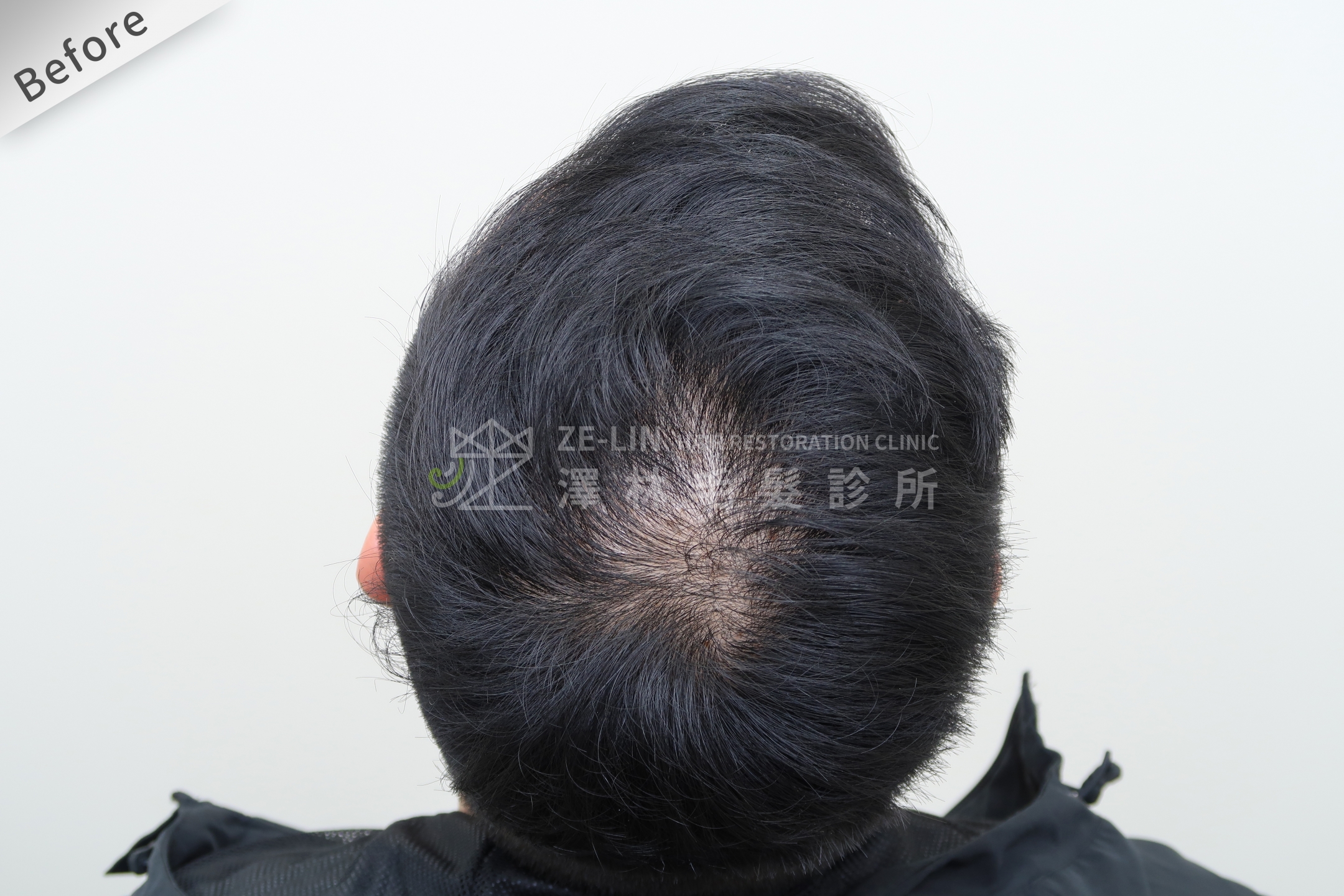 生髮育髮治療PRP自體生長因子注射治療雄性禿頂部術前3
