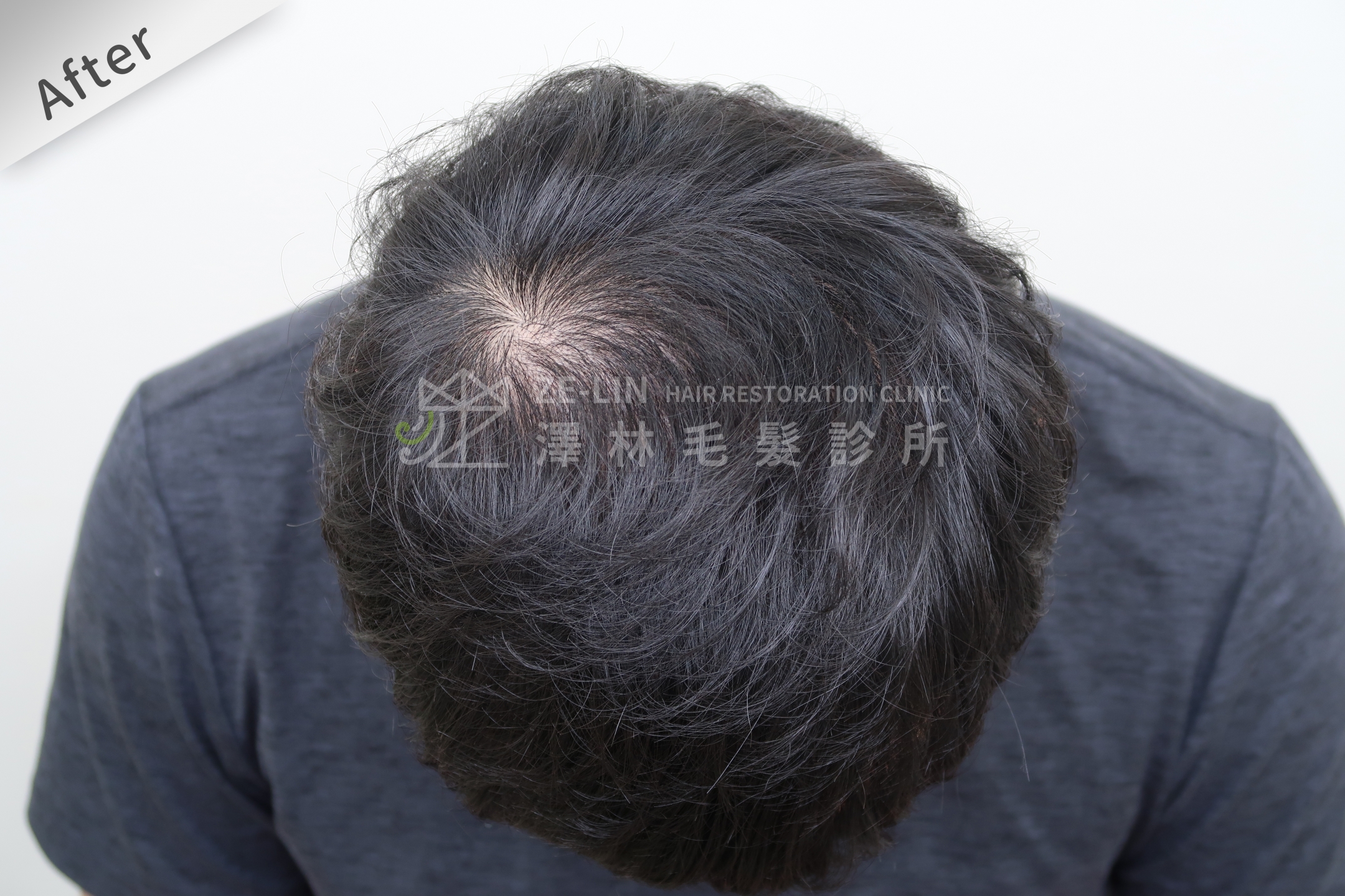雄性禿植髮評價：術後髮際線