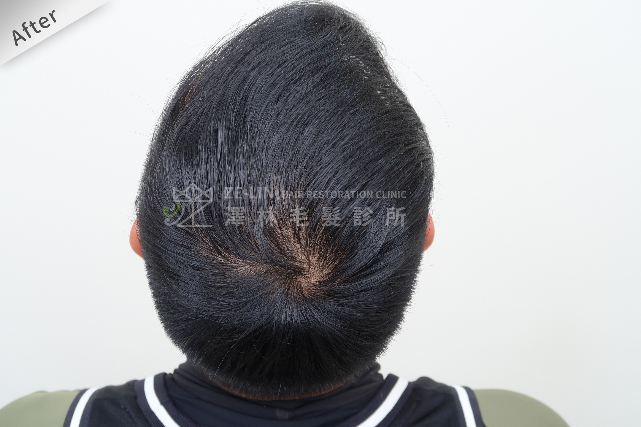 生髮育髮治療PRP自體生長因子注射治療雄性禿頂部術後3