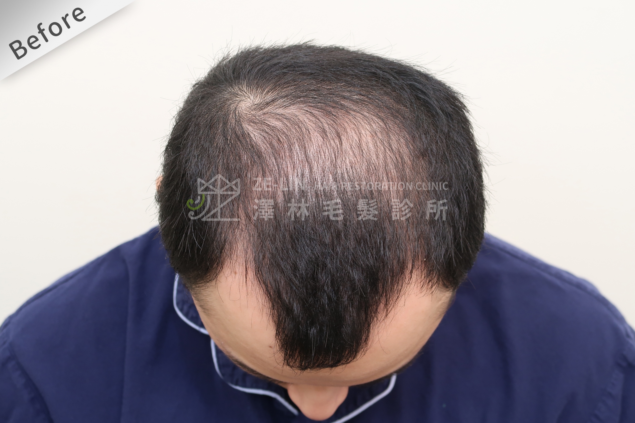 雄性禿植髮評價：術前髮際線