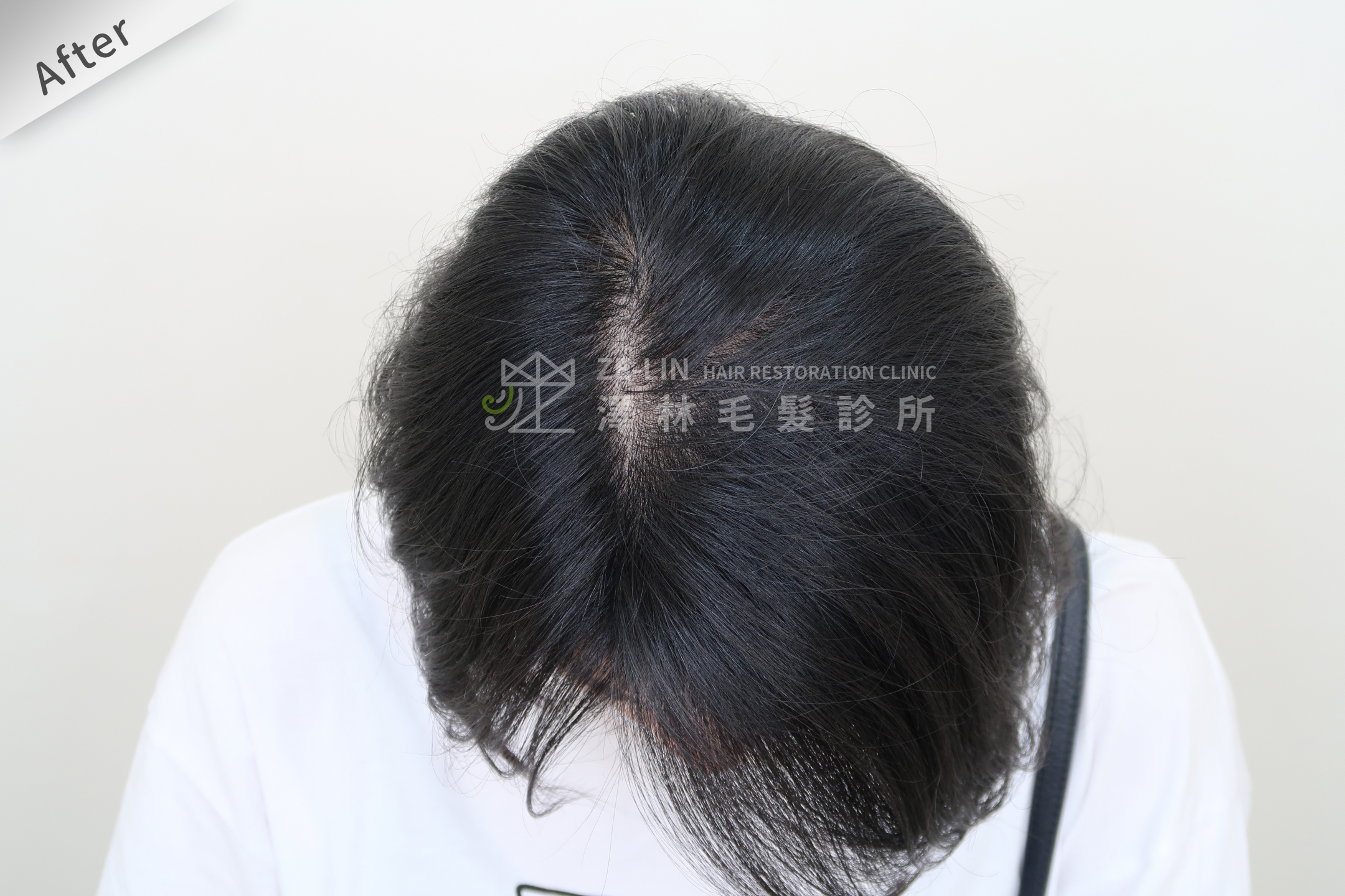PRP自體生長因子育髮治療女生雄性禿改善頭頂分線術後