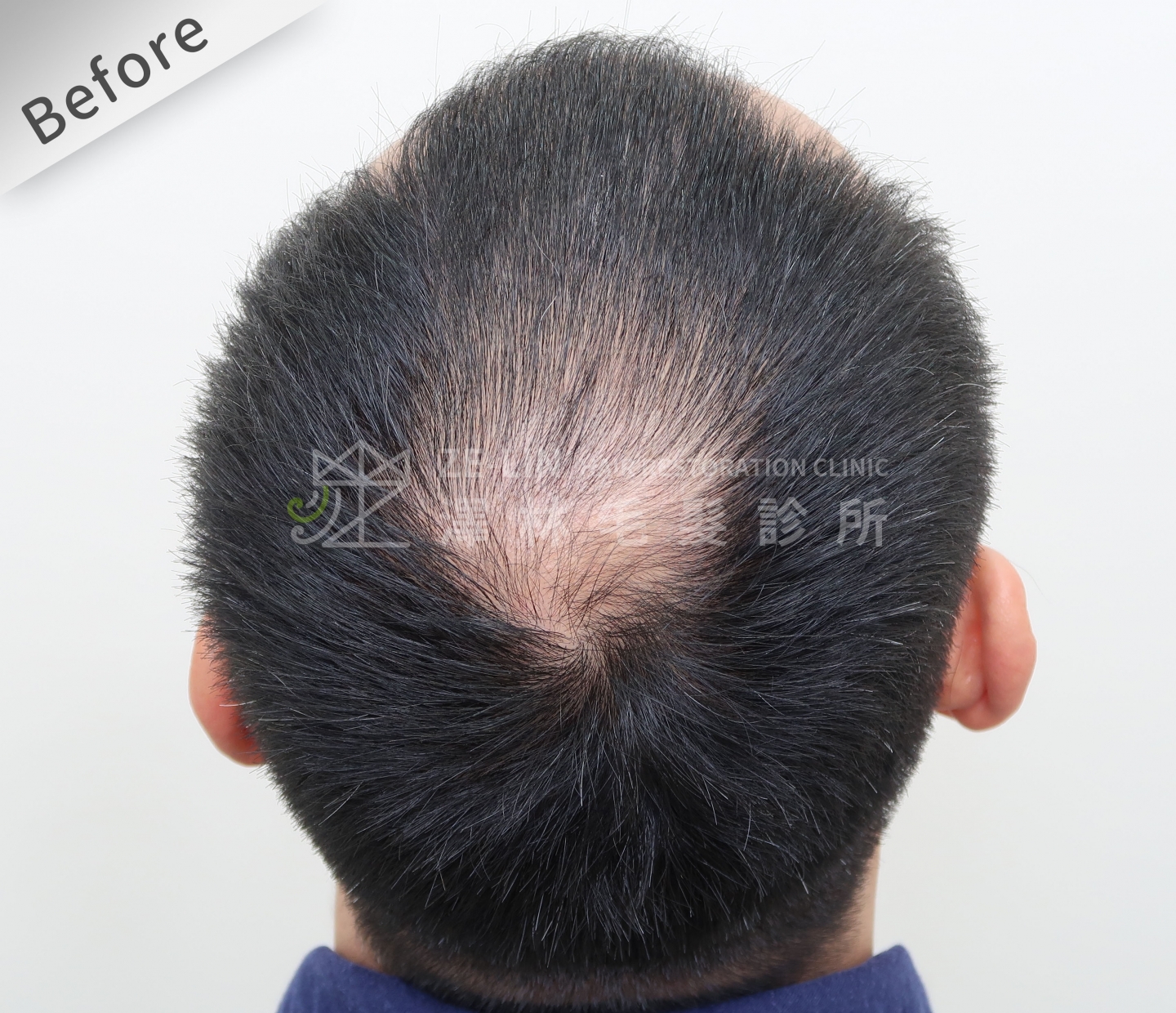 頂部地中海禿頭FUE高密度植髮心得推薦-植髮專家澤林毛髮診所謝宗廷醫師-雄性禿治療(柔沛)-術前5-1