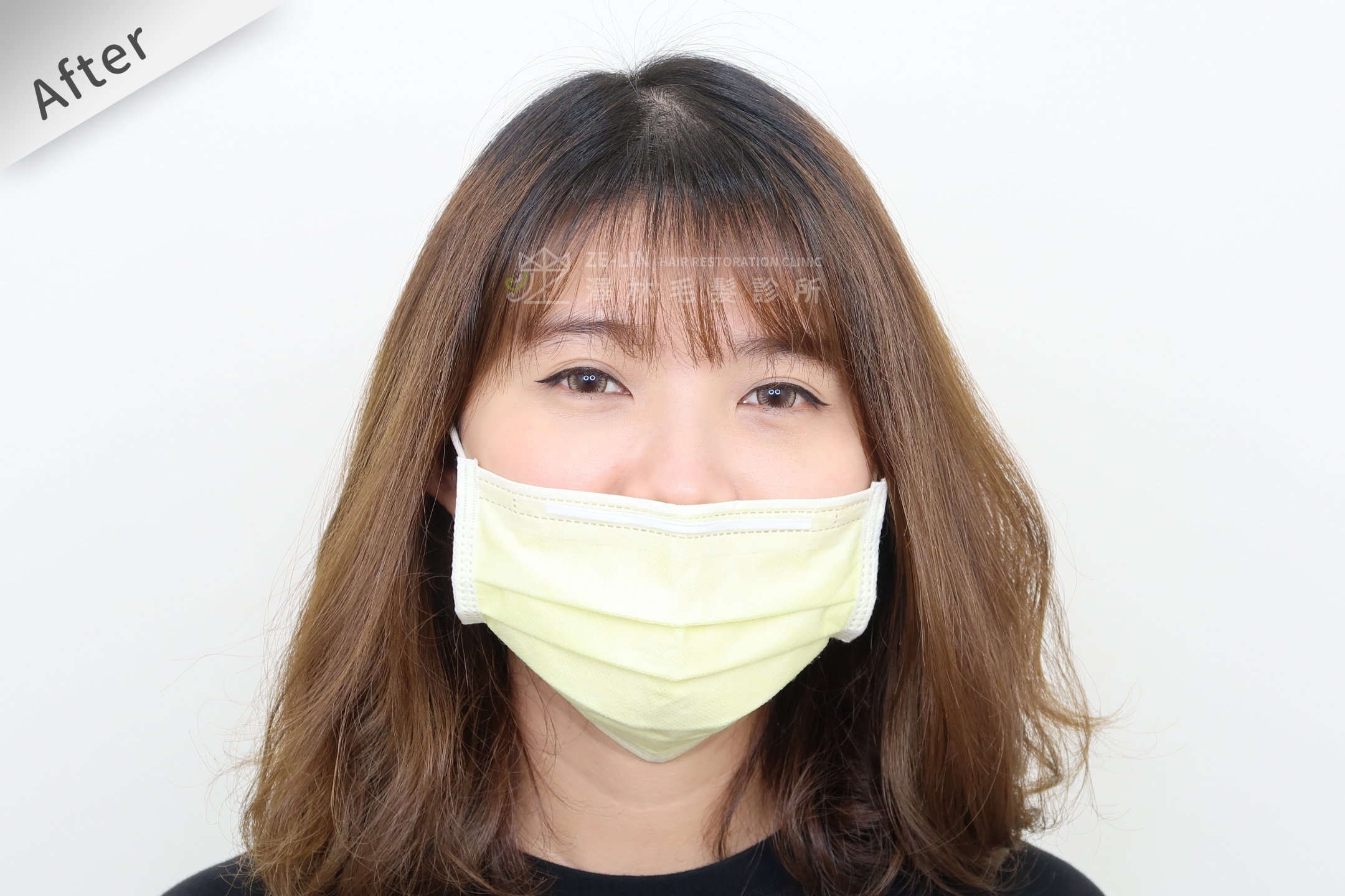 PRP自體生長因子育髮治療女生雄性禿改善頭頂看到頭皮術後(1)