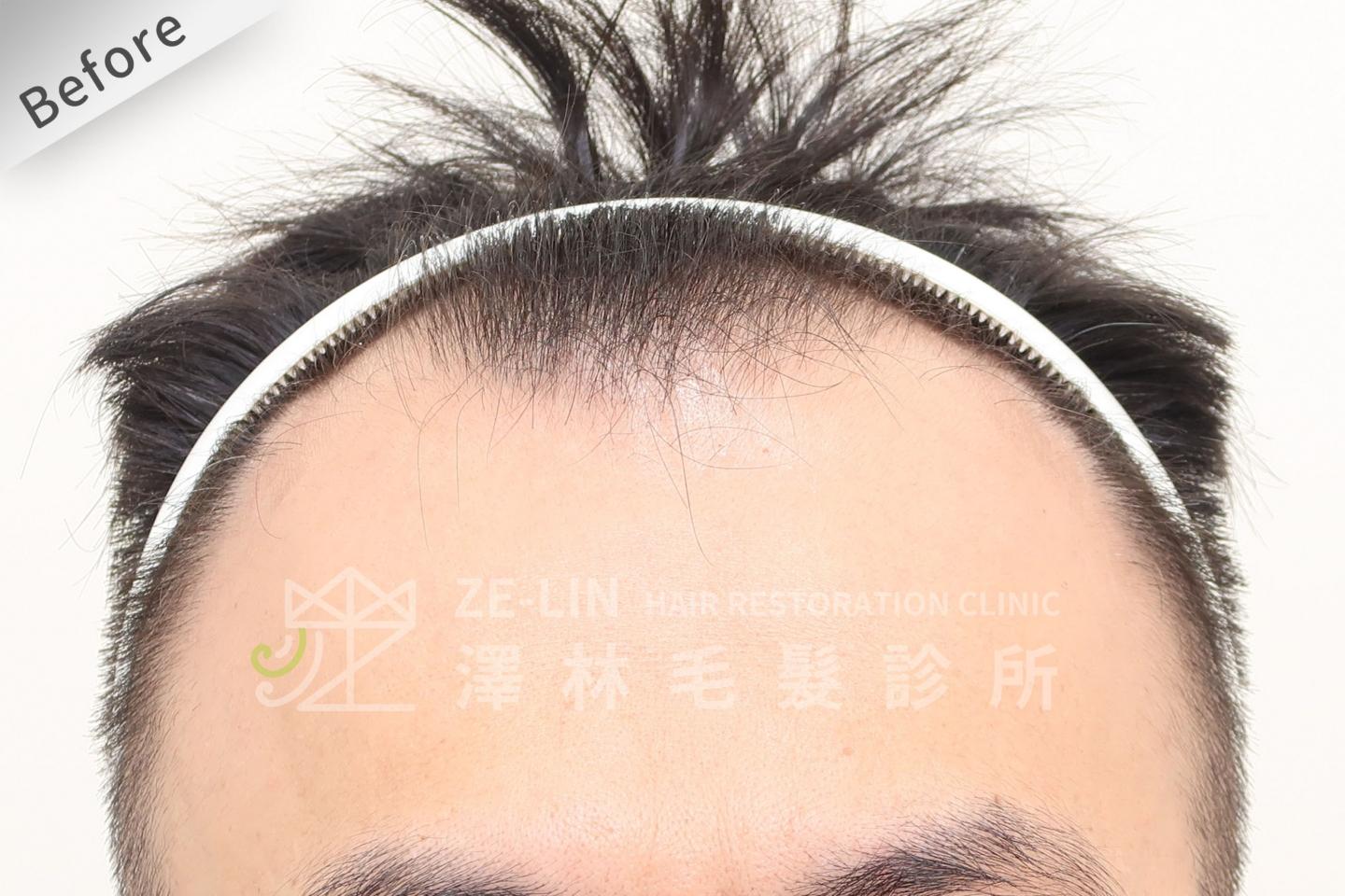 M型禿植髮推薦案例心得分享術前9-1