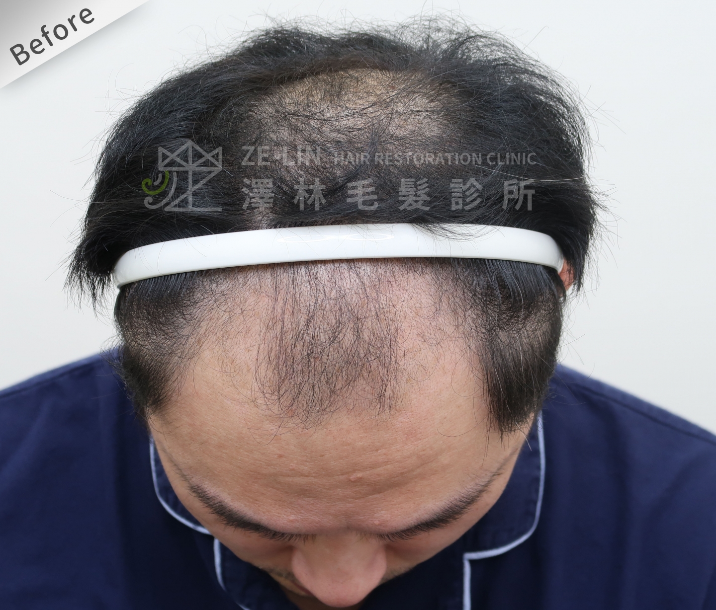 FUE植髮案例：術前髮際線