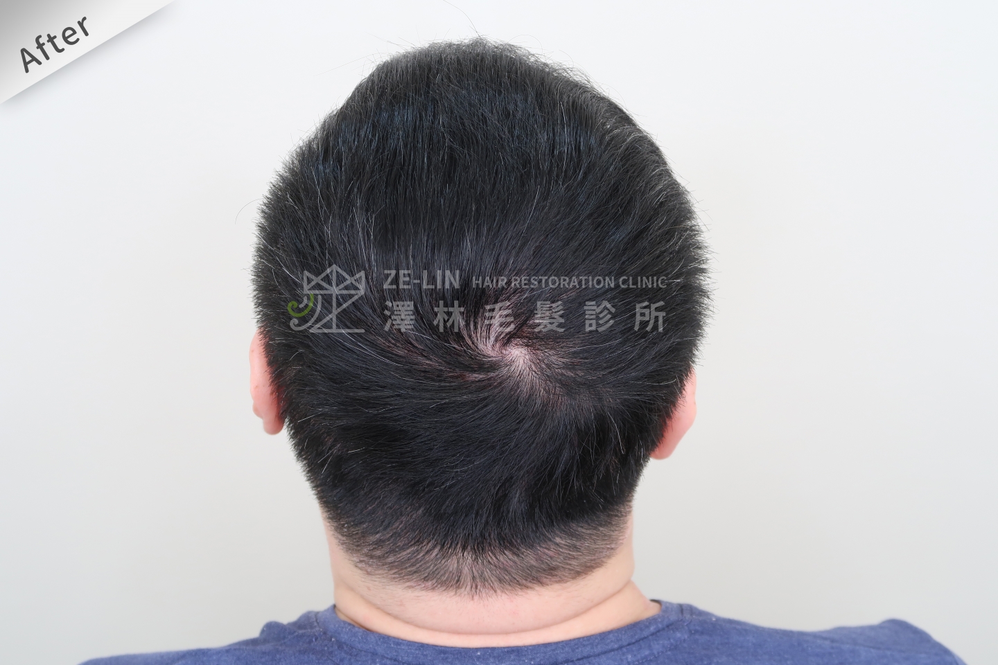頂部地中海禿頭FUE高密度植髮心得推薦-植髮專家澤林毛髮診所謝宗廷醫師-雄性禿治療(柔沛)-術後2-1