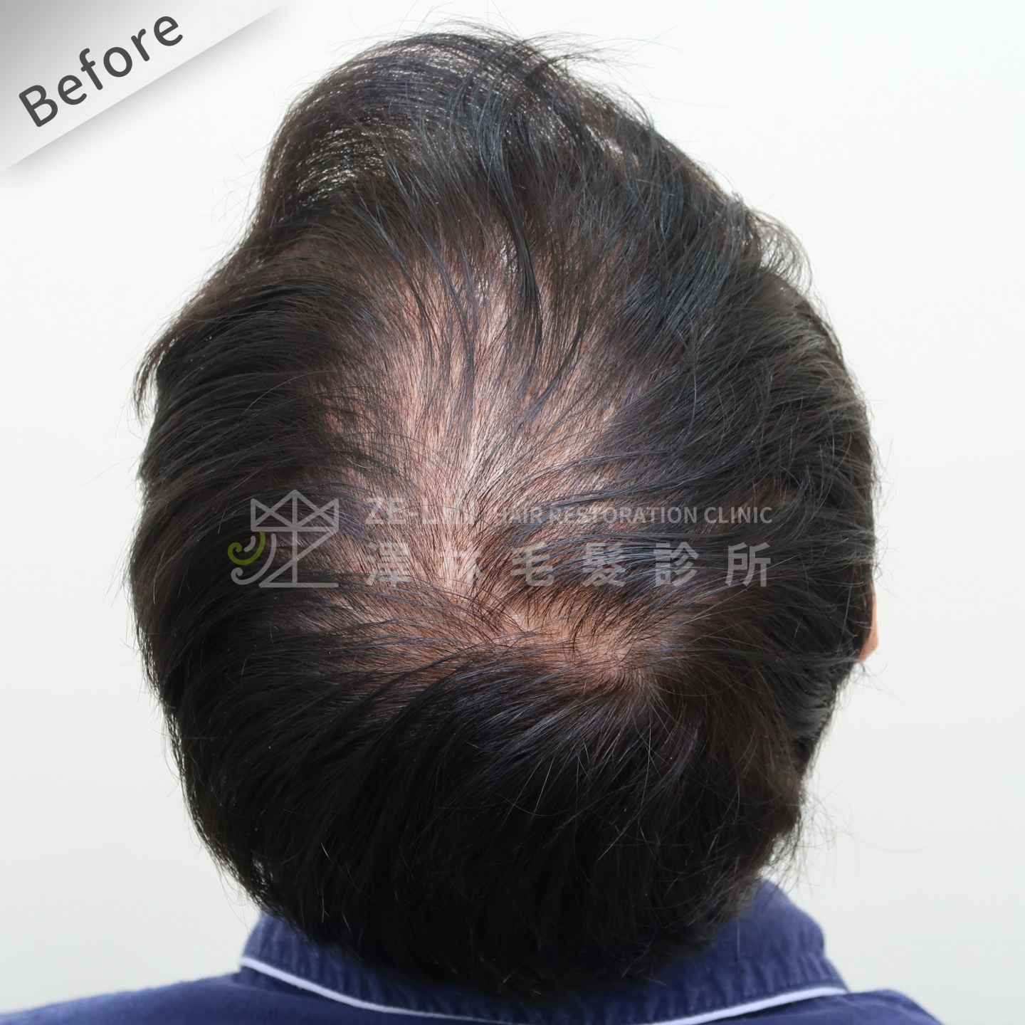 頂部地中海禿頭FUE高密度植髮心得推薦-植髮專家澤林毛髮診所謝宗廷醫師-雄性禿治療(柔沛)-術前3-1