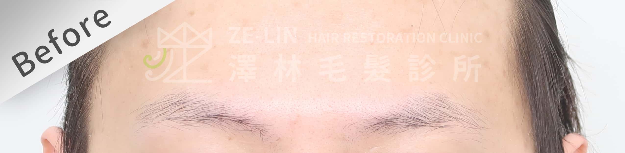 植眉推薦澤林毛髮診所謝宗廷醫師-缺眉斷眉紋眉繡眉飄眉-眉型調整-術前2-1