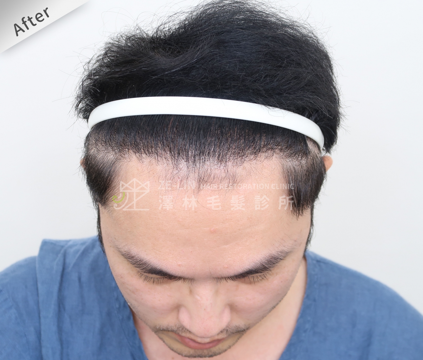 FUE植髮案例：術後髮際線
